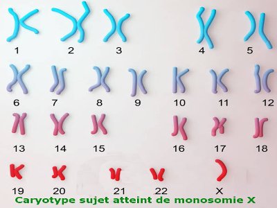 monosomie x