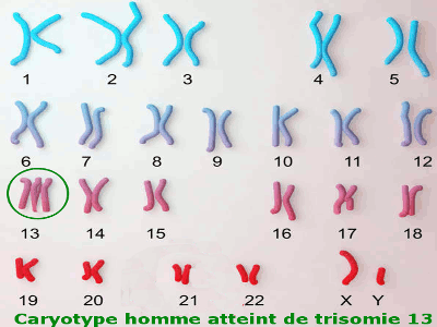 trisomie 13