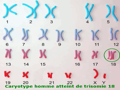 trisomie 18